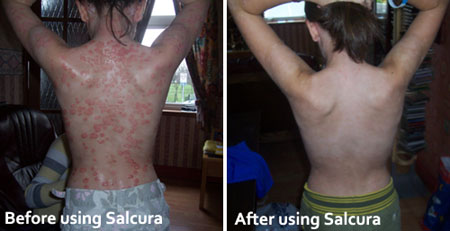 Steroid cream for guttate psoriasis